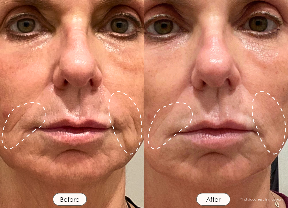 Reva radio frequency age renewal wand before and after where nasolabial folds are less prominent after use